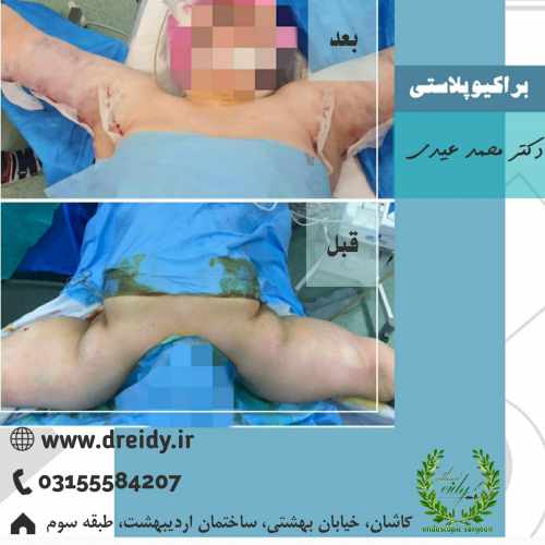 جراحی براکیوپلاستی توسط دکتر عیدی